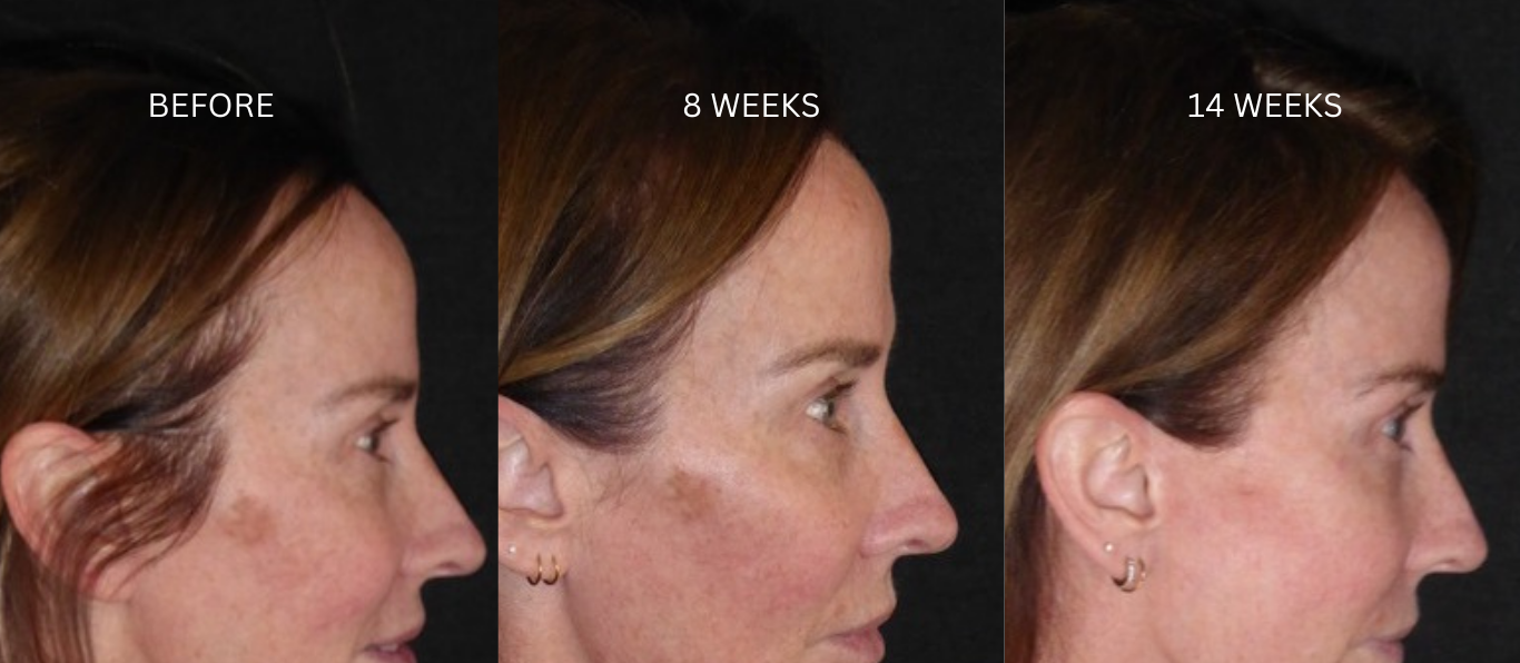 Bondi Body LED Face Mask before and after results – CEO Trish showing reduced pigmentation and improved skin tone after 8 and 14 weeks