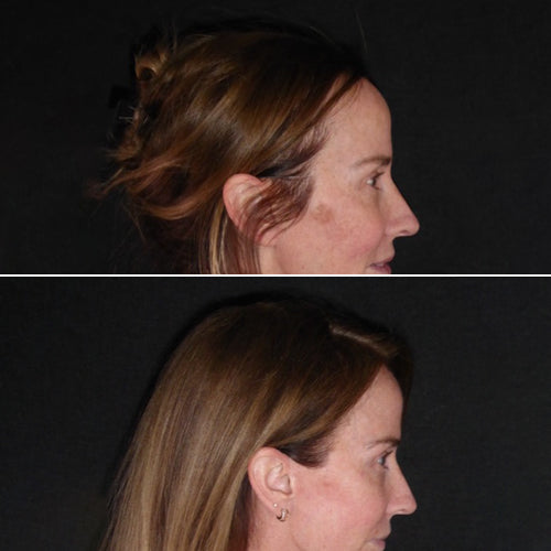 Bondi Body LED Face Mask before and after results – CEO Trish showing reduced pigmentation and improved skin tone after 8 and 14 weeks