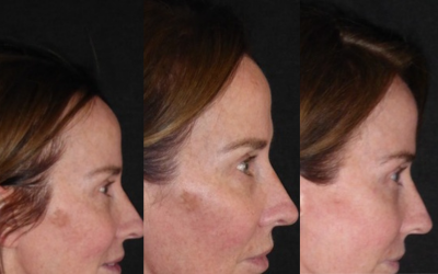 Before and after images of pigmentation, uneven skin tone. Bondi Body LED Face next and chest mask