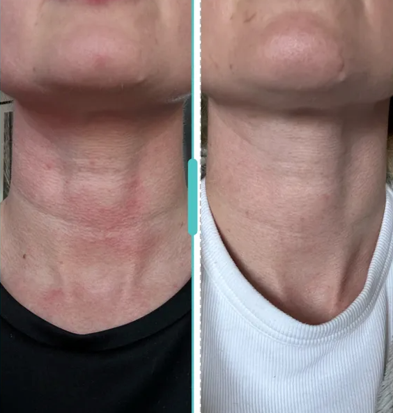 Bondi Body LED Neck and chest Mask before and after results after 6 weeks of weekly use