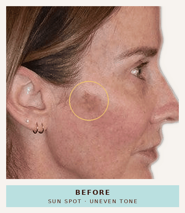 Trish, 51, before and after using the Bondi Body V2 IPL Laser at home: sun spot on cheek visibly faded and skin tone more even